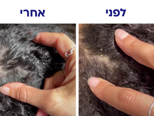 איך למנוע קשקשים? הפתרון המושלם לשיער בריא